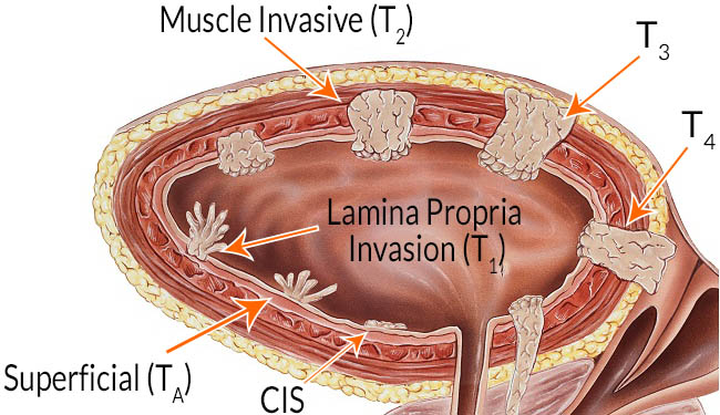 Bladder Cancer Overview Symptoms Diagnosis Treatment