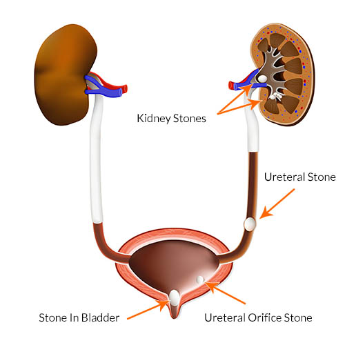 kidney stone 4mm