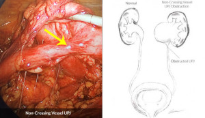 upj obstruction ureteropelvic junction