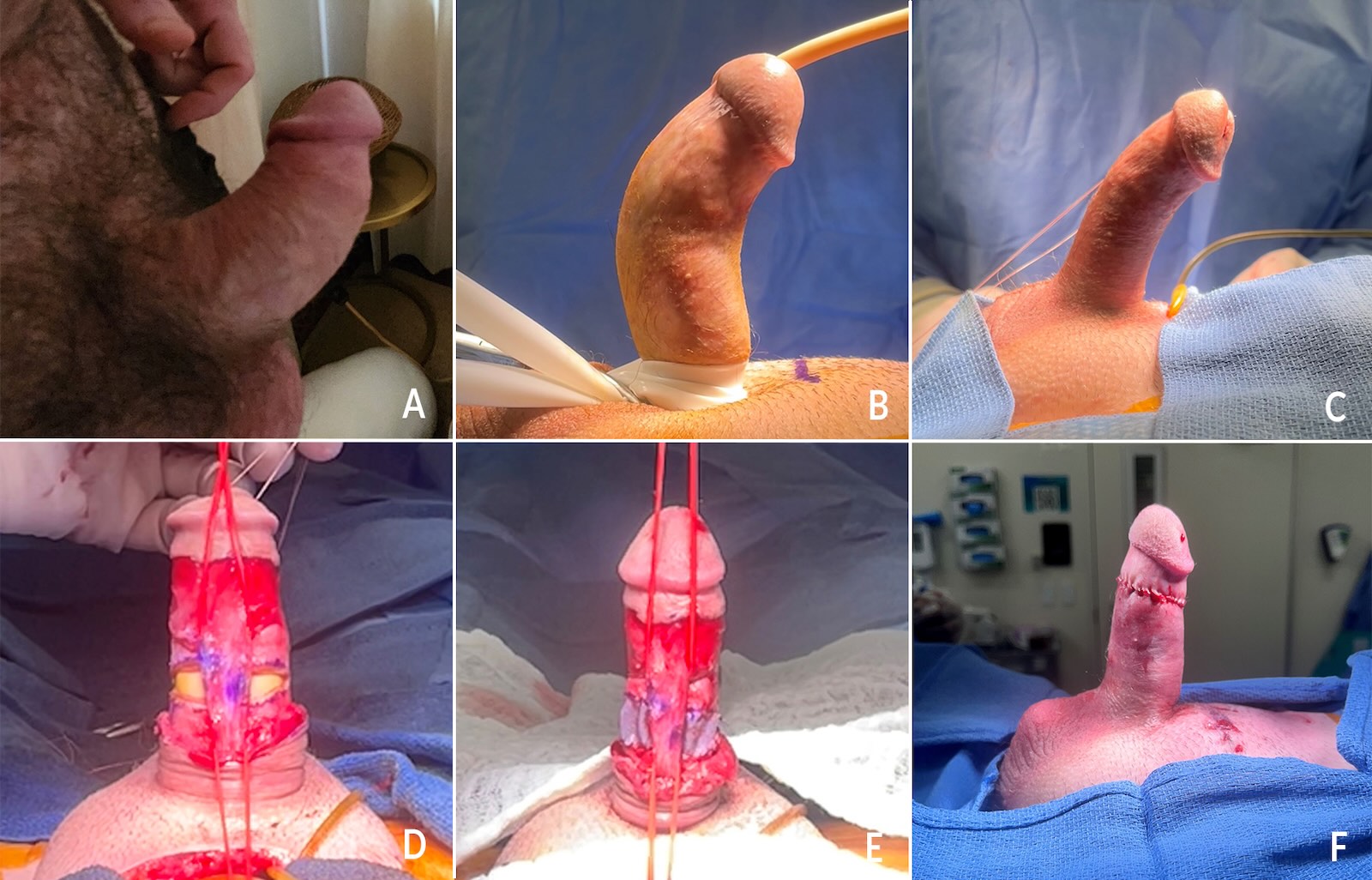 Penile Grafting for Peyronie's