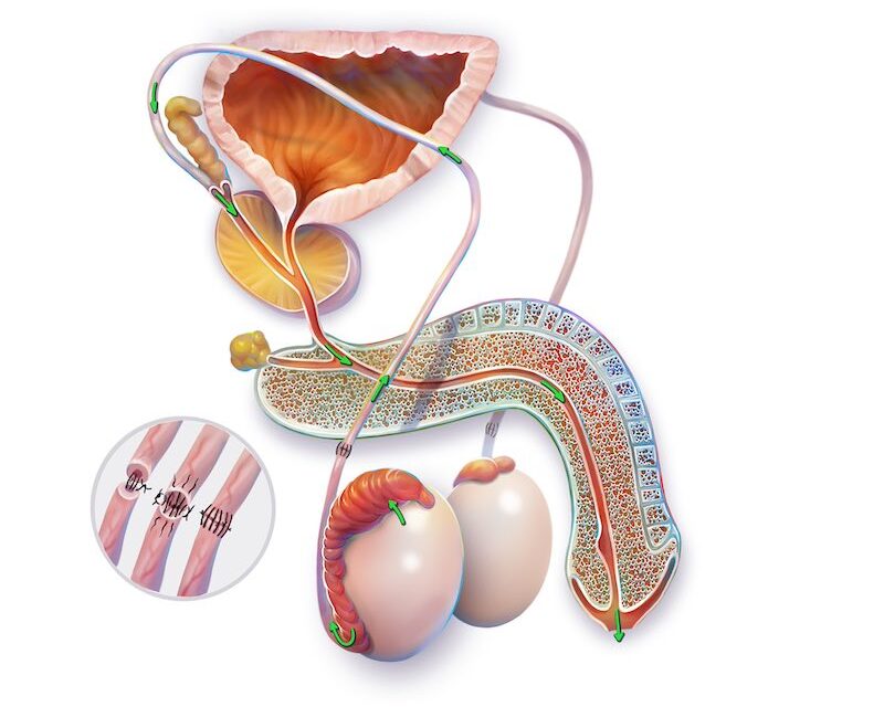 >What Does a Vasectomy Reversal Entail?